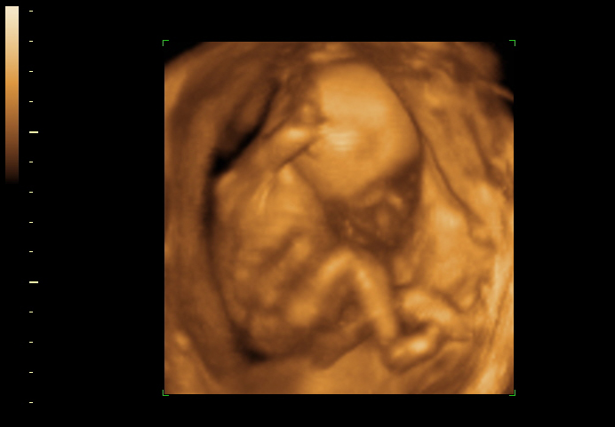 3D ultrasound image at 19 weeks